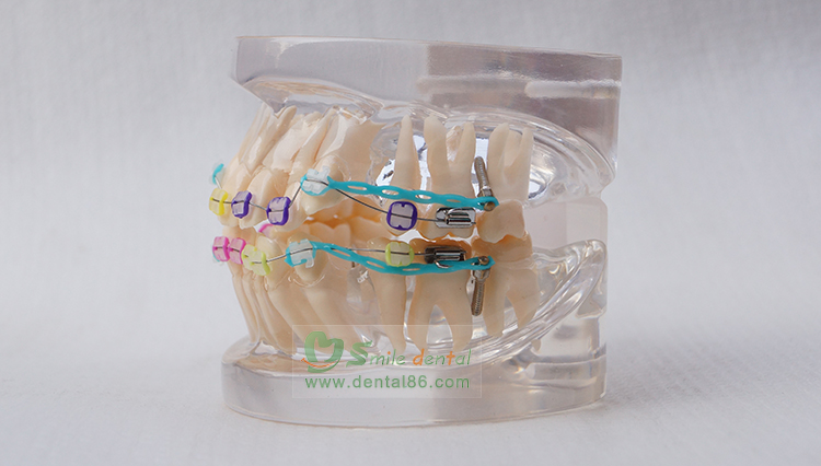 TM-B2-03 Orthodontic Model